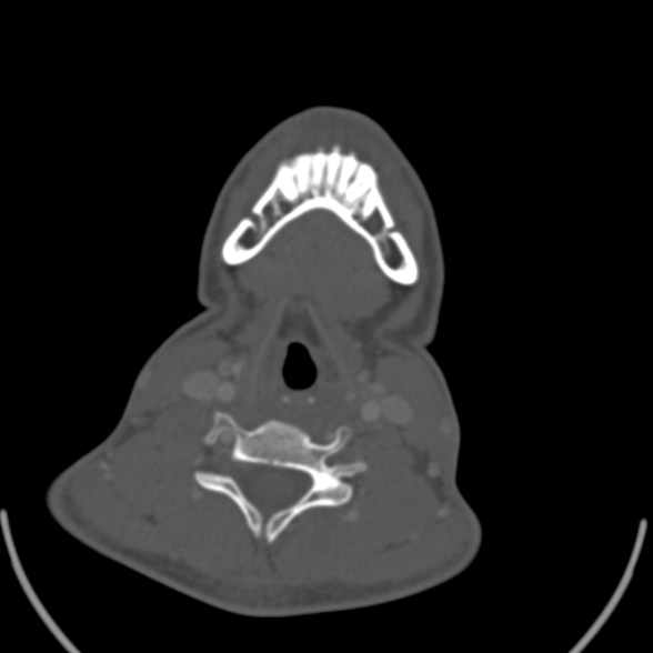 Nasopharyngeal carcinoma with skull base invasion (Radiopaedia 53415-59705 Axial bone window 143).jpg