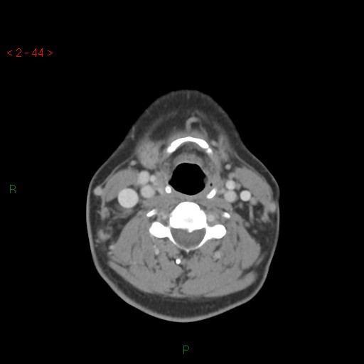 File:Nasopharyngeal lymphoma (Radiopaedia 54235-60433 A 12).jpg