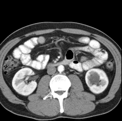 File:Necrotizing pancreatitis with acute necrotic collection (Radiopaedia 14470-14417 B 25).jpg
