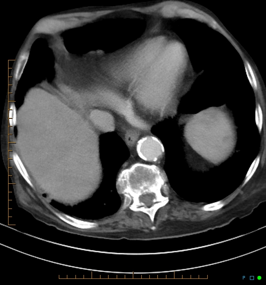 Necrotzing fasciitis due to a perforated adenocarcinoma of the splenic flexure (Radiopaedia 46930-51455 A 15).jpg