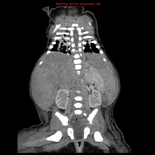 File:Neonatal neuroblastoma (Radiopaedia 9564-10223 B 89).jpg