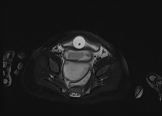 Neonatal prostatic utricle abscess - cyst (Radiopaedia 69511-79394 Axial T2 fat sat 21).jpg