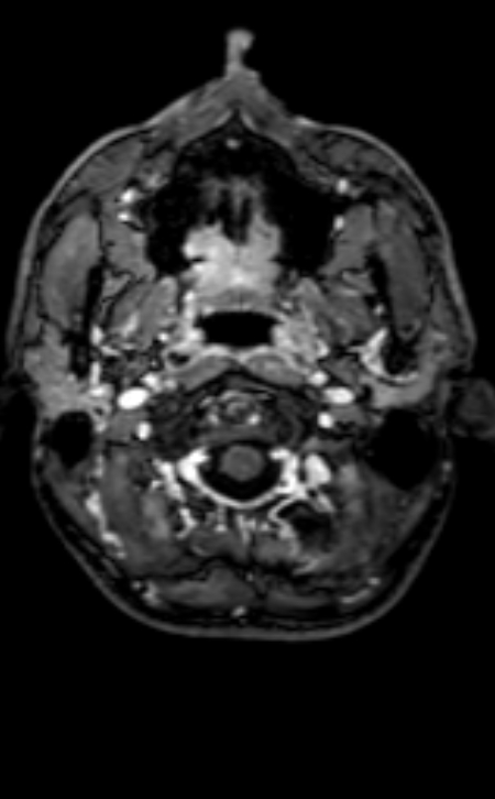 Neuro-Behçet disease (Radiopaedia 90112-107294 Axial T1 C+ 200).jpg