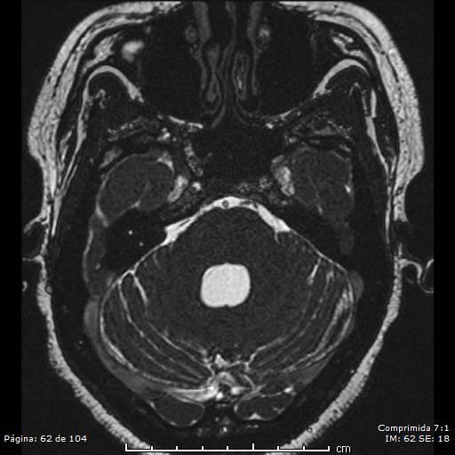 Neurocysticercosis (Radiopaedia 58636-65832 I 62).jpg