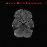 File:Neurofibromatosis type 1 with optic nerve glioma (Radiopaedia 16288-15965 Axial DWI 40).jpg