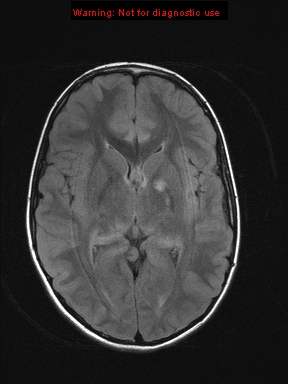 File:Neurofibromatosis type 1 with optic nerve glioma (Radiopaedia 16288-15965 Axial FLAIR 13).jpg