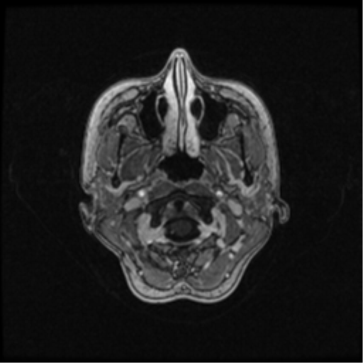Neurofibromatosis type 2 (Radiopaedia 45229-49244 Axial T1 C+ 22).png