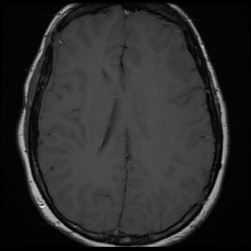 File:Neurofibromatosis type 2 (Radiopaedia 45229-49251 Axial T1 22).png