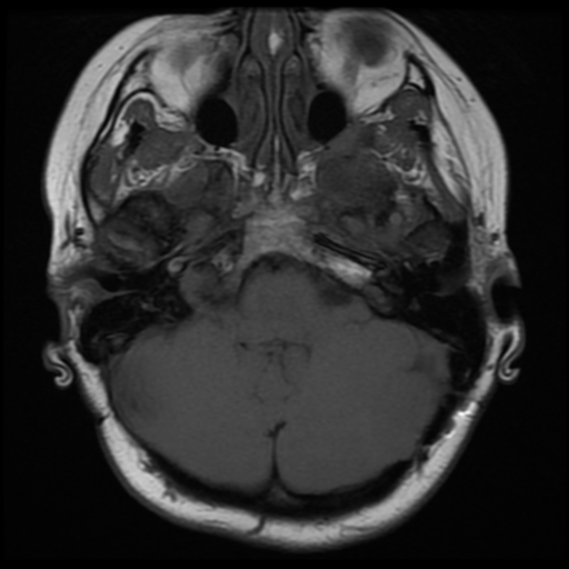 File:Neurofibromatosis type 2 (Radiopaedia 45229-49251 Axial T1 9).png