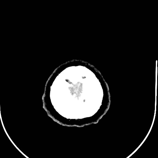 Neurofibromatosis type 2 (Radiopaedia 79097-92047 Axial non-contrast 60).jpg