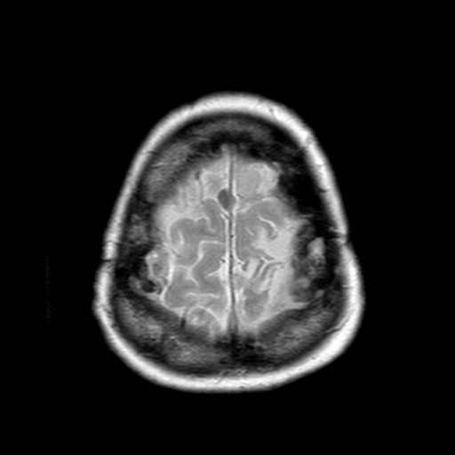 File:Neurofibromatosis type 2 (Radiopaedia 8713-9518 Axial Gradient Echo 3).jpg