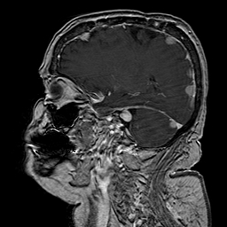 File:Neurofibromatosis type 2 (Radiopaedia 8713-9518 Sagittal T1 C+ 18).jpg