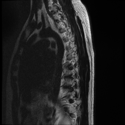 File:Neurofibromatosis type 2 (spinal manifestations) (Radiopaedia 53943-60070 C 3).png