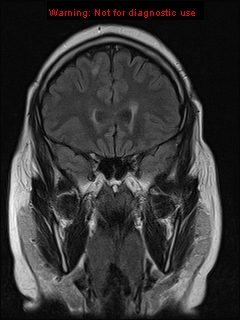 File:Neuroglial cyst (Radiopaedia 10713-11184 Coronal FLAIR 18).jpg