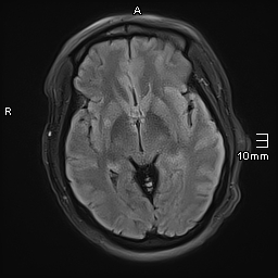 File:Neurotoxoplasmosis - concentric target sign (Radiopaedia 70644-80784 Axial FLAIR 10).jpg