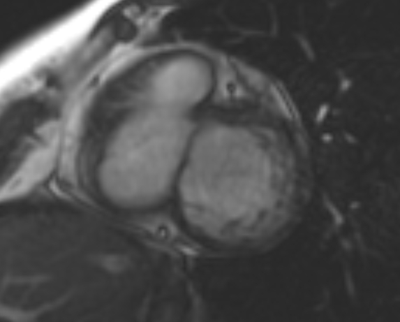 File:Non-compaction of the left ventricle (Radiopaedia 69436-79314 Short axis cine 170).jpg