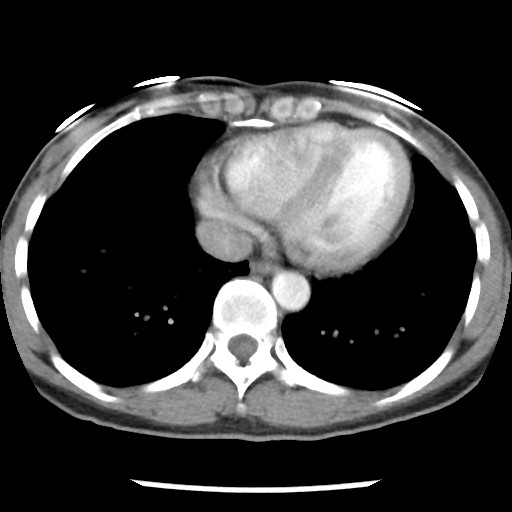 File:Non-small cell lung cancer with miliary metastases (Radiopaedia 23995-24193 A 31).jpg