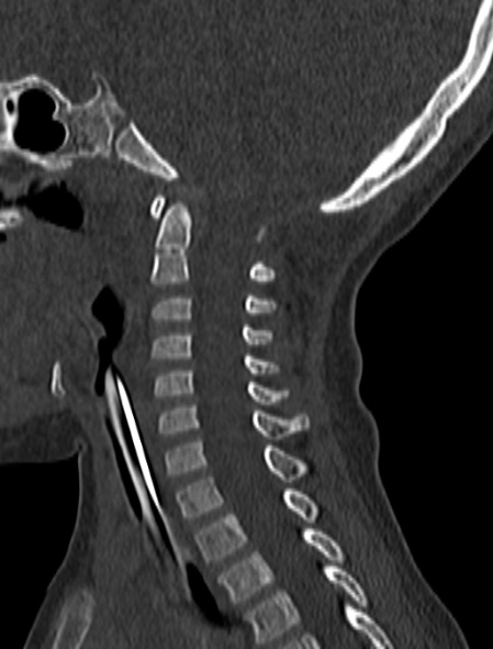 Normal CT cervical spine - pediatric (Radiopaedia 52549-58462 Sagittal bone window 112).jpg