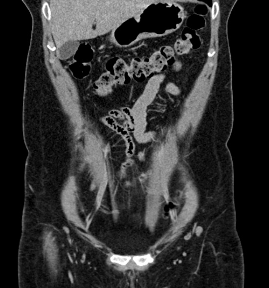 File:Normal CT intravenous urogram (Radiopaedia 39444-41759 A 200).jpg