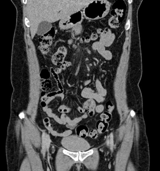 Normal CT intravenous urogram (Radiopaedia 39444-41759 A 214).jpg