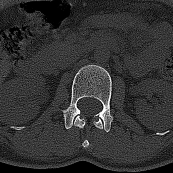 File:Normal CT lumbar spine (Radiopaedia 53981-60118 Axial bone window 21).jpg