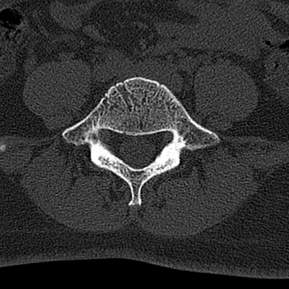 File:Normal CT lumbar spine (Radiopaedia 53981-60118 Axial bone window 58).jpg