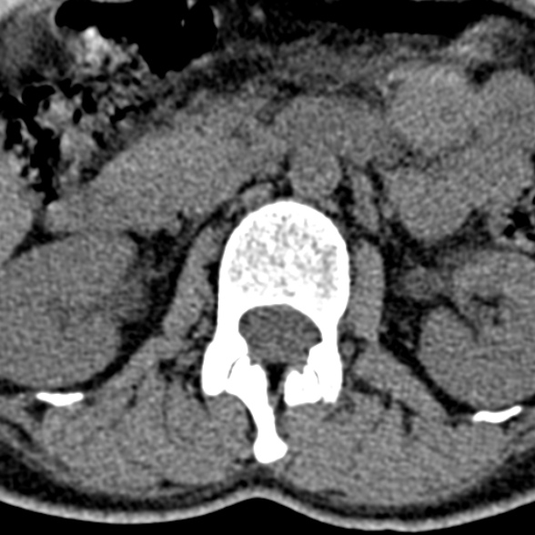 Normal CT lumbar spine (Radiopaedia 53981-60118 Axial non-contrast 28).jpg