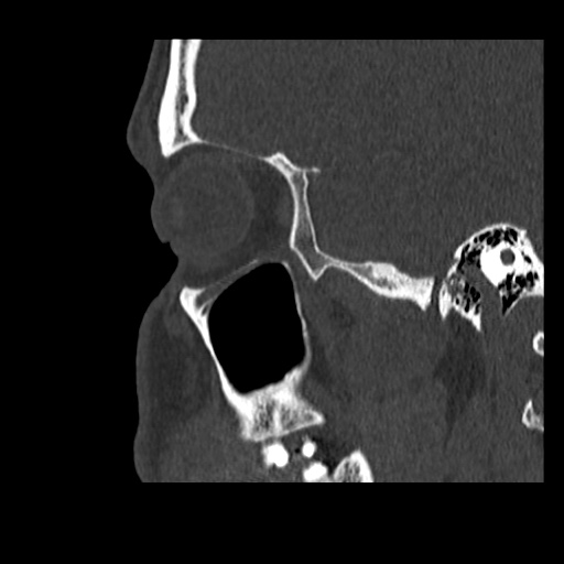 Normal CT paranasal sinuses (Radiopaedia 42286-45390 Sagittal bone window 20).jpg