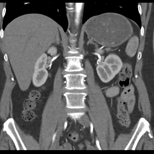 File:Normal CT renal artery angiogram (Radiopaedia 38727-40889 B 45).png