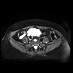 Normal MRI abdomen in pregnancy (Radiopaedia 88005-104548 Axial DWI 29).jpg