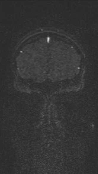 Normal MRI brain with MRV- teenager (Radiopaedia 49425-54553 Coronal MRV 49).jpg