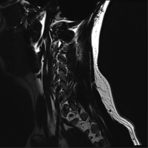 File:Normal MRI cervical spine (infection protocol) (Radiopaedia 53916-60039 F 1).png