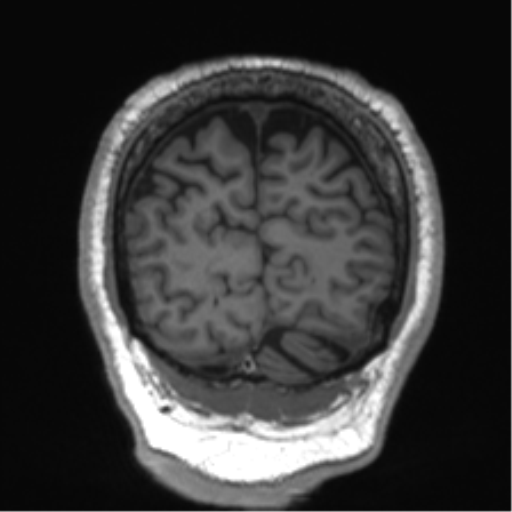 Normal brain MRI (non-focal epilepsy protocol) (Radiopaedia 53917-60040 Coronal T1 13).png