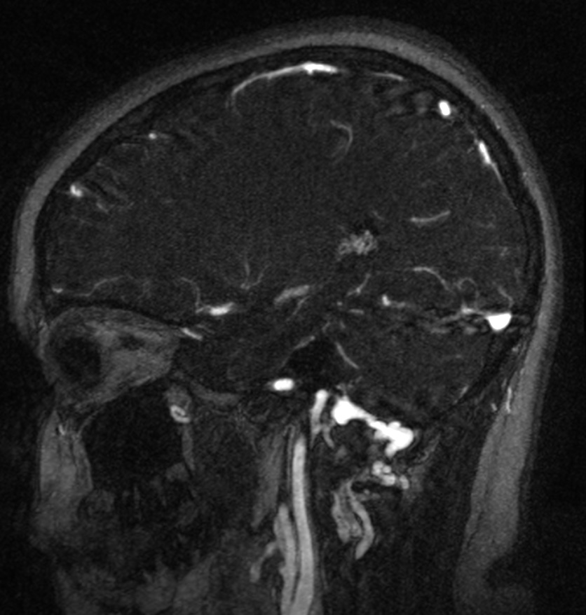 Normal brain MRI and venogram (Radiopaedia 39554-41862 Sagittal MRV 45).jpg