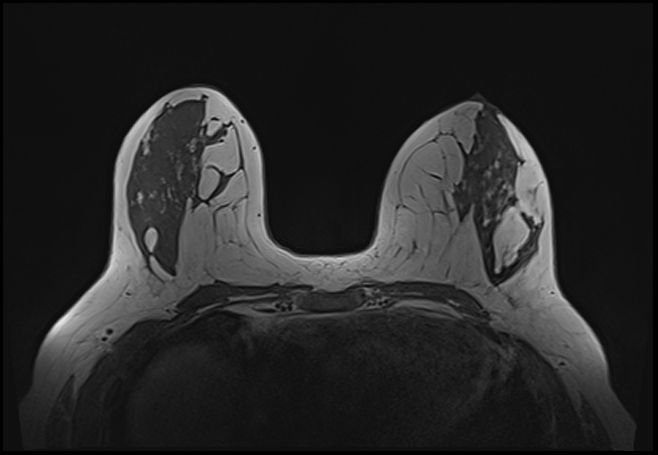 File:Normal breast MRI - dense breasts (Radiopaedia 80454-93850 Axial T1 100).jpg