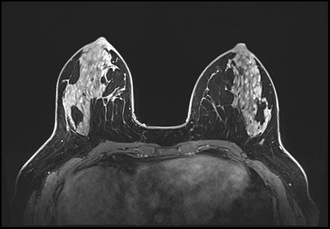 Normal breast MRI - dense breasts (Radiopaedia 80454-93850 C 91).jpg
