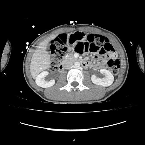 File:Normal dual-phase trauma CT chest,abdomen and pelvis (Radiopaedia 48092-52900 Axial 1).jpg