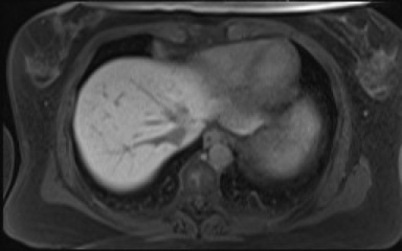 File:Normal hepatobiliary phase liver MRI (Radiopaedia 58968-66230 A 17).jpg