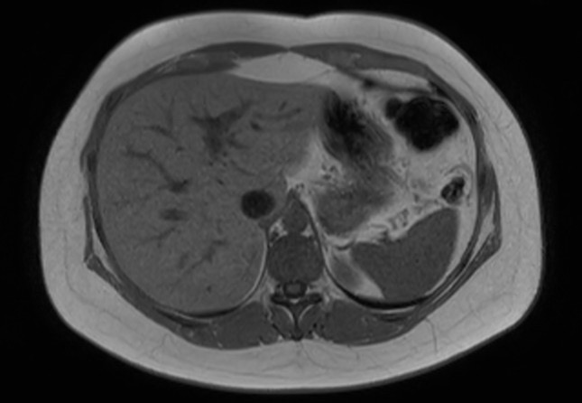 File:Normal liver MRI with Gadolinium (Radiopaedia 58913-66163 Axial T1 in-phase 23).jpg