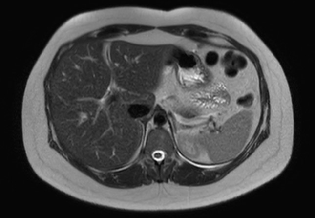 File:Normal liver MRI with Gadolinium (Radiopaedia 58913-66163 Axial T2 22).jpg