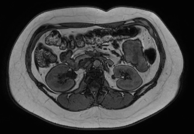 File:Normal liver MRI with Gadolinium (Radiopaedia 58913-66163 B 12).jpg
