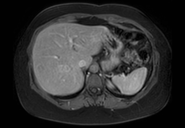 Normal liver MRI with Gadolinium (Radiopaedia 58913-66163 J 54).jpg