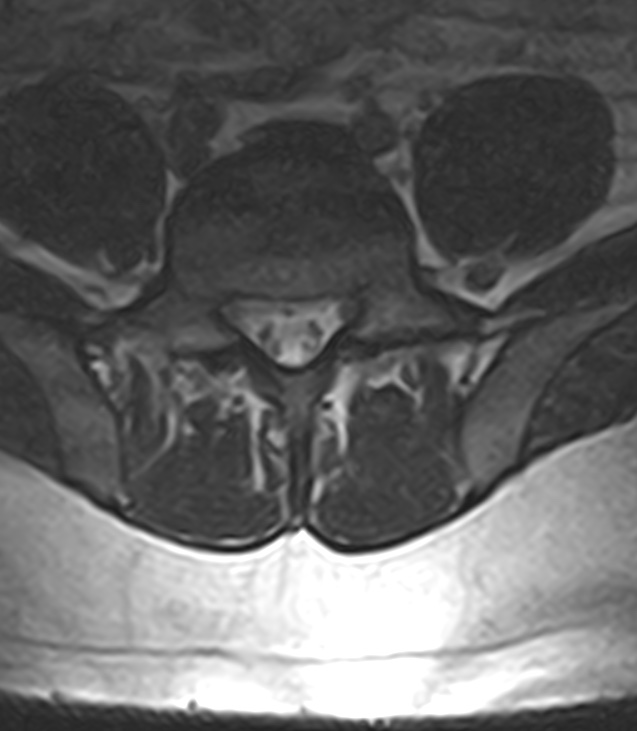 Normal lumbar spine MRI - low-field MRI scanner (Radiopaedia 40976-43699 Axial T2 80).jpg
