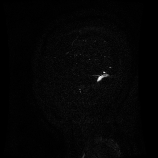 Normal noncontrast MR venography (Radiopaedia 87578-103957 A 156).jpg