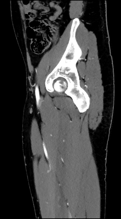 Normal pelvis CT angiogram (Radiopaedia 84966-100481 C 32).jpg