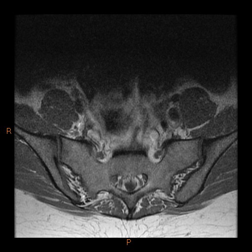 File:Normal spine MRI (Radiopaedia 77323-89408 Axial T1 30).jpg