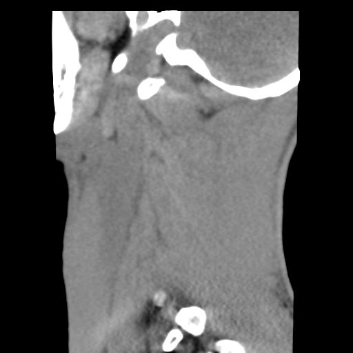 File:Normal trauma cervical spine (Radiopaedia 41017-43760 B 26).png