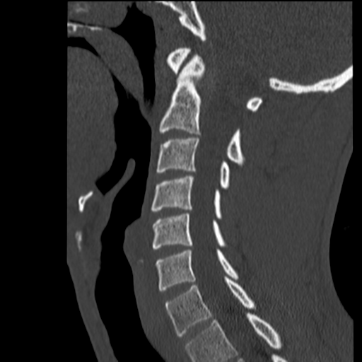 File:Normal trauma cervical spine (Radiopaedia 41017-43760 Sagittal bone window 19).png