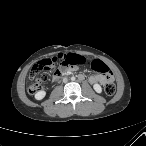 File:Nutmeg liver- Budd-Chiari syndrome (Radiopaedia 46234-50635 B 36).png