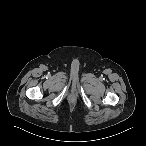 Obstructing sigmoid adenocarcinoma (Radiopaedia 58465-65619 A 176).jpg